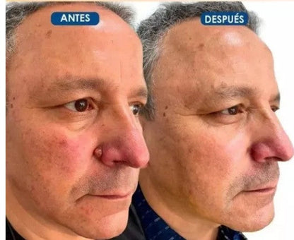😳 2X1 FORMUCLEAR - ELIMINA VERRUGAS SIN DOLOR Y SEGURO + ENVIO GRATIS🚚